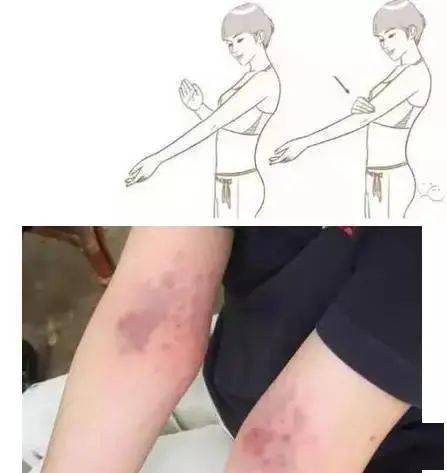 como e quando surgiu a televisão_colonia de formigas_como clarear hematomas